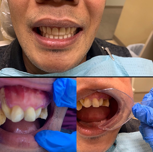 implant dentures2