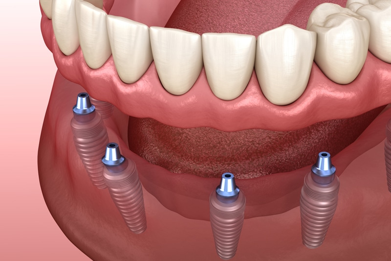implant dentures